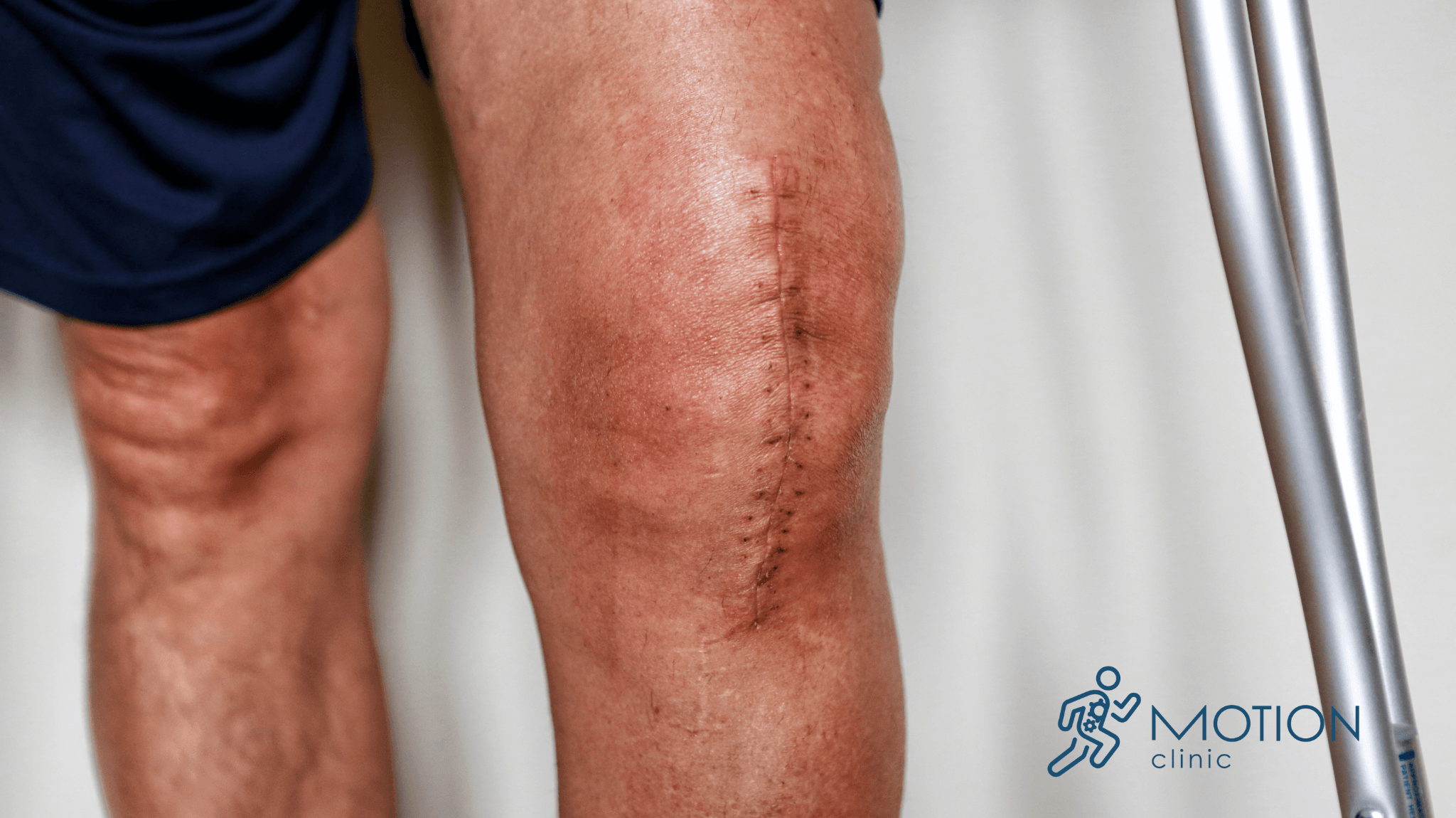 endoproteza stawu kolanowego motionclinic