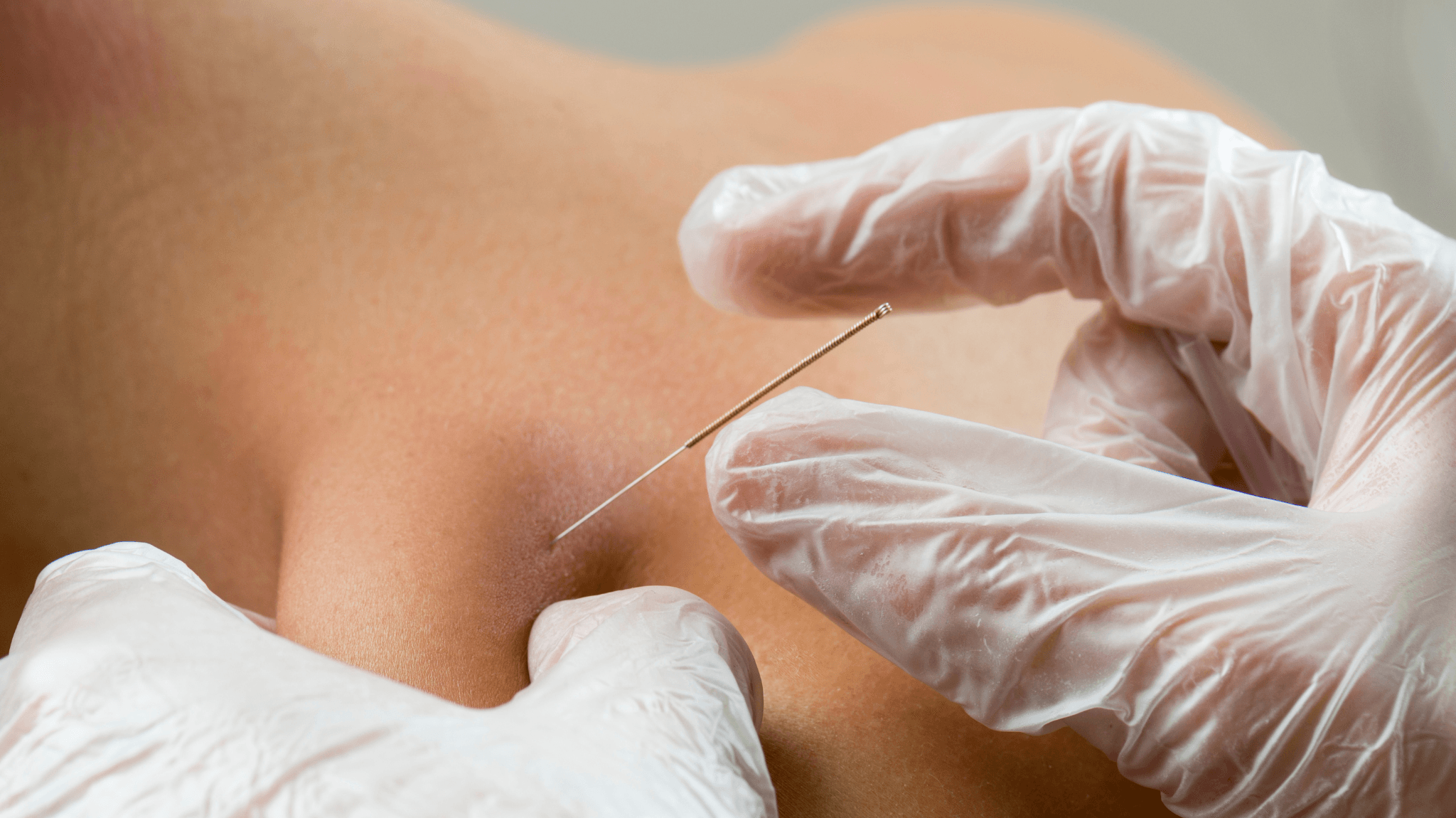 suche igłowanie MotionClinic