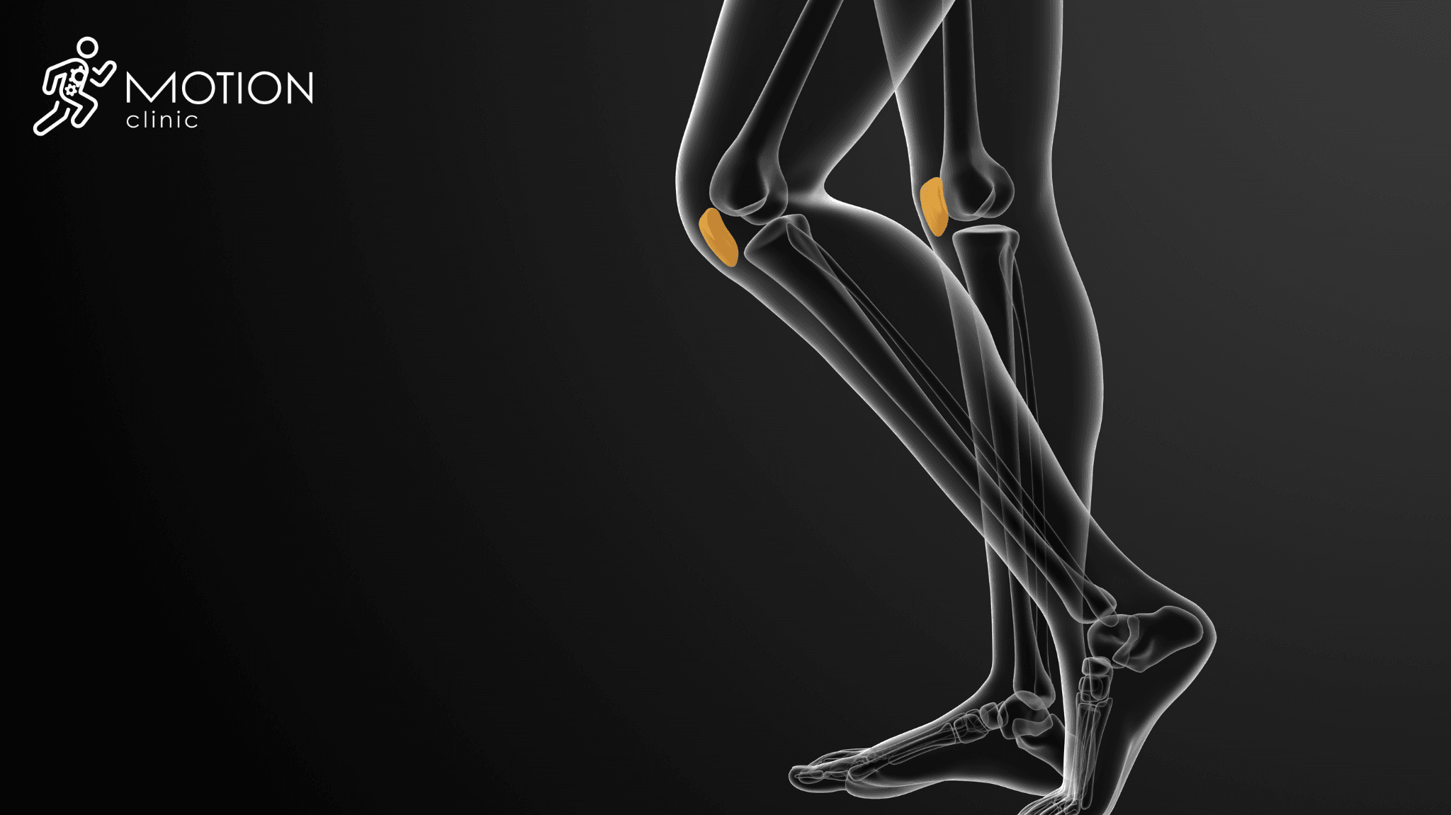 chondromalacja rzepki MotionClinic